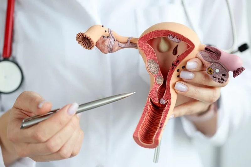 Endometriosis Surgery